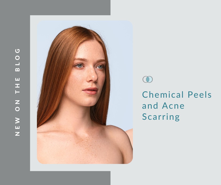 Chemical Peels and Acne Scarring | Palo Alto Laser & Skin Care